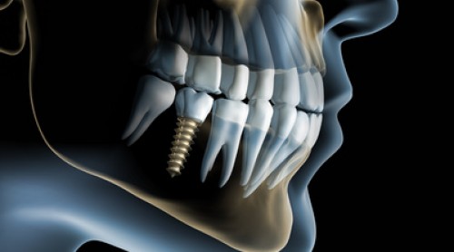 Cirugía Maxilofacial-Implantología